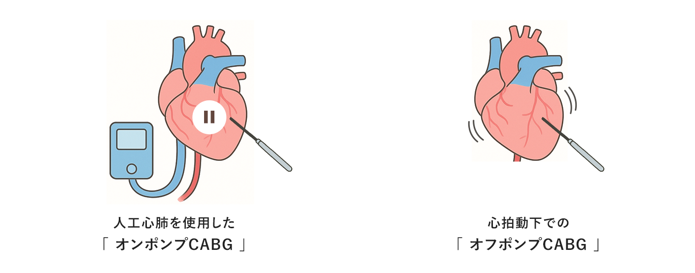 オンポンプCABG