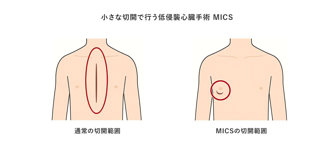 MICS