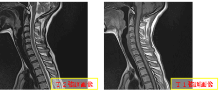 T2強調画像 T1強調画像