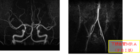 下肢血管MRA（FBI法）