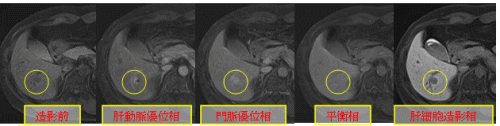 造影前 肝動脈優位相 門脈優位相 平衡相 肝細胞造影相