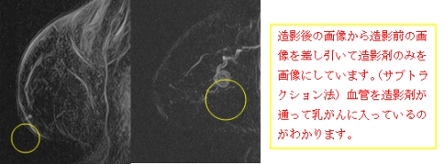 造影後の画像から造影前の画像を差し引いて造影剤のみを画像にしています。（サブトラクション法）血管を造影剤が通って乳がんに入っているのがわかります。