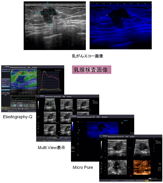 乳がんエコー画像 乳腺検査画像