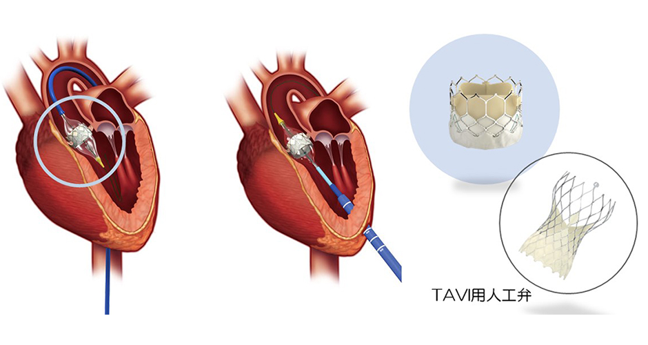 TAVI図